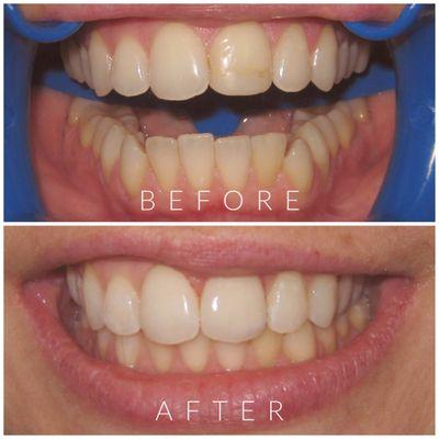 A Dental Veneer was placed on the top front tooth (#9) to fix discoloration and make the smile more uniform.