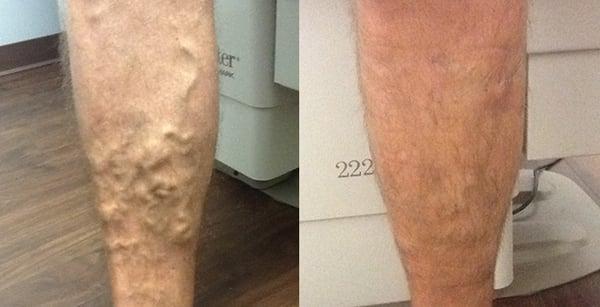 Varicose Vein Closure with VNUS Venefit