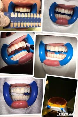 Whitening procedure, come and get yours and get a brighter Smile.