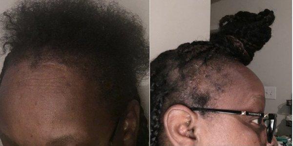 Before and after using Essentials Of Eden Hair Grow Kit.