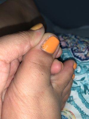 Infected toe because she cut too deep and it was PAINFUL. I can't walk correctly because of how much it hurts.