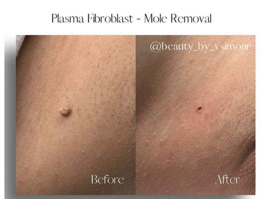 Before and right after mole/skin tag removal