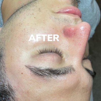 Results of pore extractions