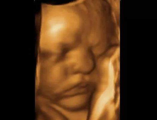 Fetal Memories 2D 3D 4D Ultrasound