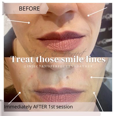 Smile lines treated with dermal filler!
 We also do cheek contouring for added lift which helps with smile lines as well!