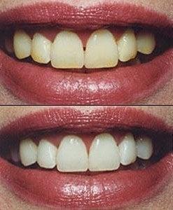 Teeth whitening, before and after shot
