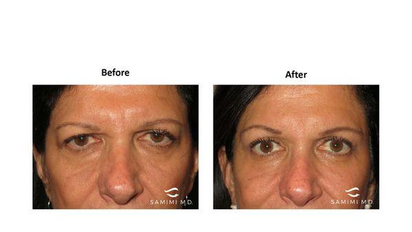 She is shown after an upper blepharoplasty, lower blepharoplasty, ptosis repair, and browlift.