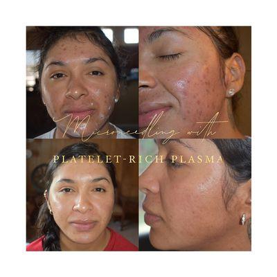 Microneedling with PLatelet-Rich Plasma