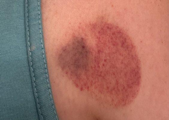 Cupping bruise :(