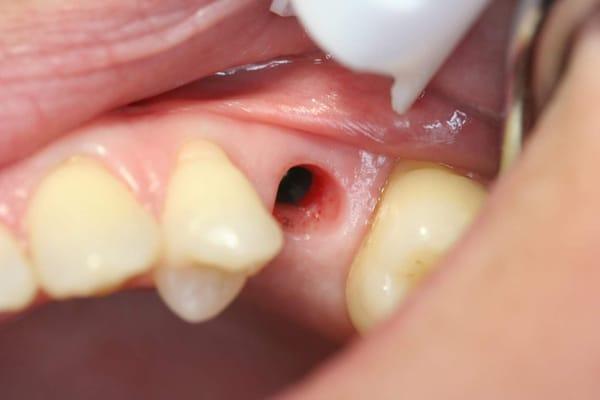 Implant case by Dr. Hani Jamah