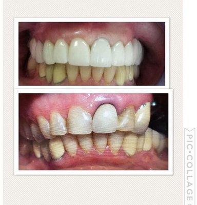 upper full mouth rehabilitation combination of crowns, implants and veneers