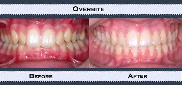 Our Work: Example of Overbite before and after treatment