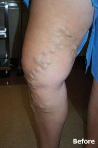 Patient 3 - varicose vein treatment BEFORE