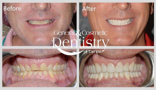 Full Mouth Reconstruction by Dr. Michael Diez Dentist near Westchase