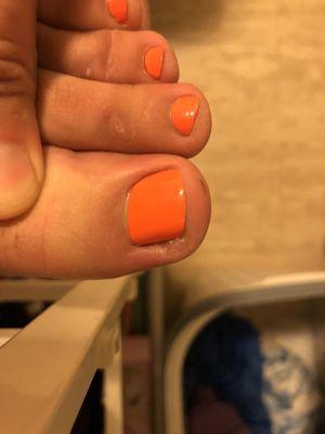 Left big toe infection.