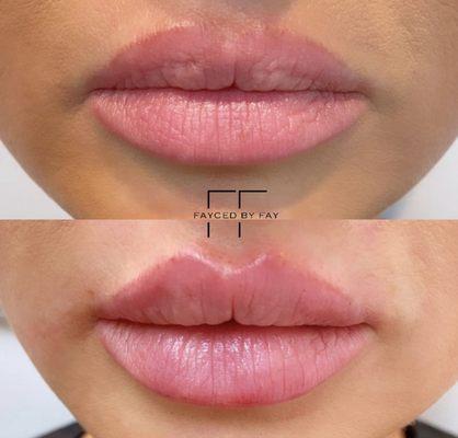 Lip Augmentation by Nurse Fay.