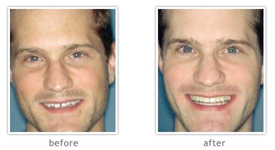 Veneers help close gaps refining function and appearance.