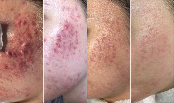 Acne progression