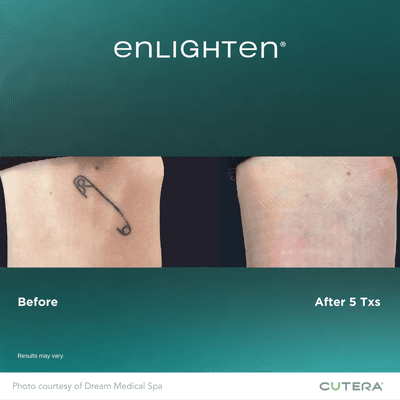 Tattoo Removal with cutting edge technology  that allows quicker, more effective treatments