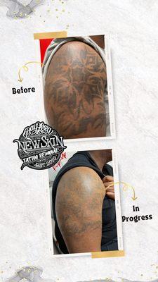 In Progress Tattoo removal on darker skin.