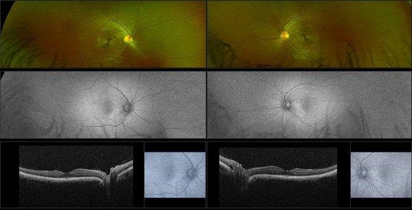 The best technology to diagnose and treat eye disease like glaucoma, macula degeneration, and diabetes