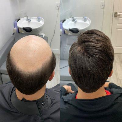 Before and after non surgical hair replacement