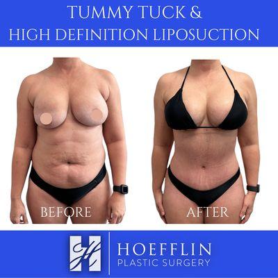 Dr. Hoefflin performs highly sculpted tummy tucks in combination with both Vaser high def liposuction and J Plasma for skin tightening.