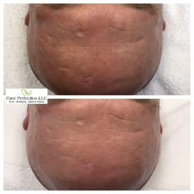 Micro Needling Scar Treatment