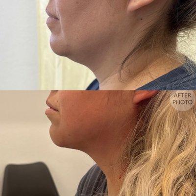 Chin liposuction