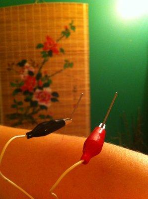 Acupuncture with electric stimulation