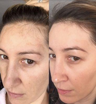 Hyperpigmentation, before/ after