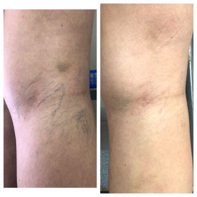 Back of the knee spider veins, before and after.