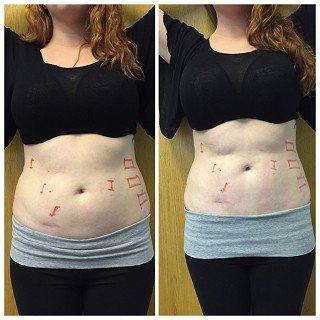 Scar reduction seen after just 1 treatment with the Strawberry Laser Lipo!