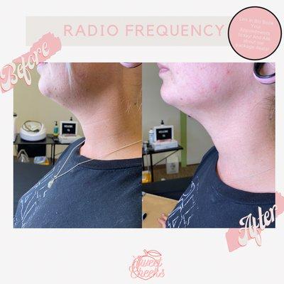 Before and After - Radio Frequency skin tightening