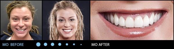 Mo's before & after at Scottsdale Dental Arts!