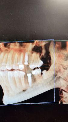 Dental Implants