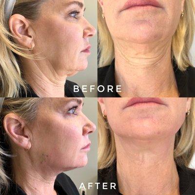 PDO Thread Neck Lift: define jawline and reduce wrinkles