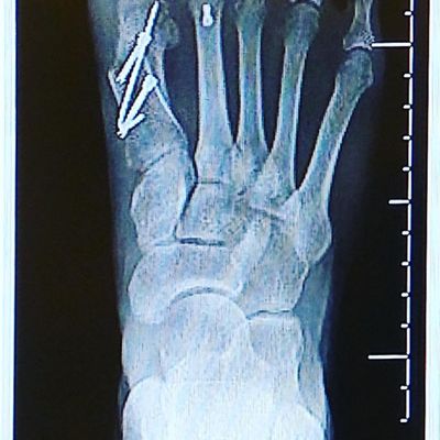 Right foot after correction