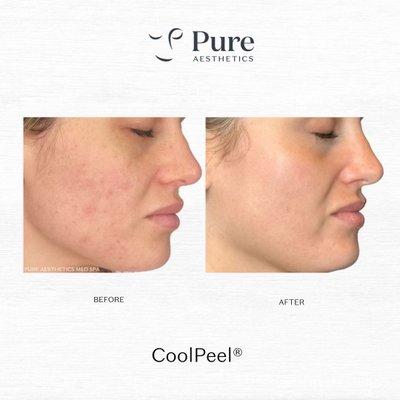 CoolPeel at Pure Aesthetics