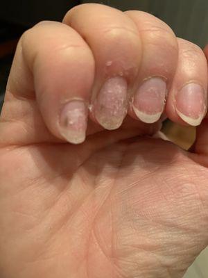 Green spots on natural nail