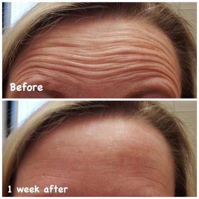 Dysport brand botox results.