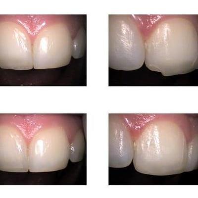 Chipped front tooth repair with bonding - Pt chipped her tooth grinding her teeth while she was sleeping.  It woke her up!!