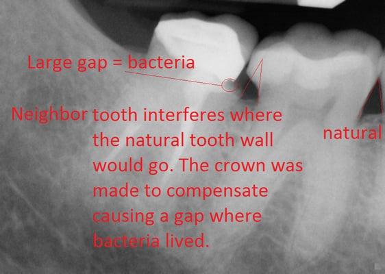 Tooth #31 (left) and #30 (right). Existing crown (pre-op). See mark-ups for what Dr. Nguyen explained to me.