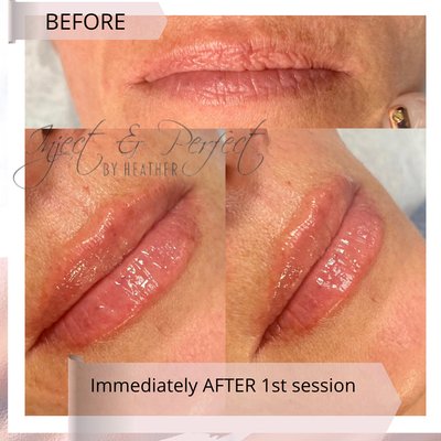 enhance your natural beauty. Here's a natural lip plumpening session done with lip fillers