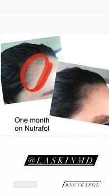 Treatment for hair loss with Nutrafol