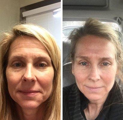 Great results from chemical peels, also called non-surgical facelift for a reason. Beautiful.