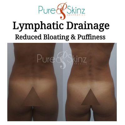 Results After Just 4 Sessions * Lymphatic Sculpting Lymphatic Drainage * Lymphatic Well-being