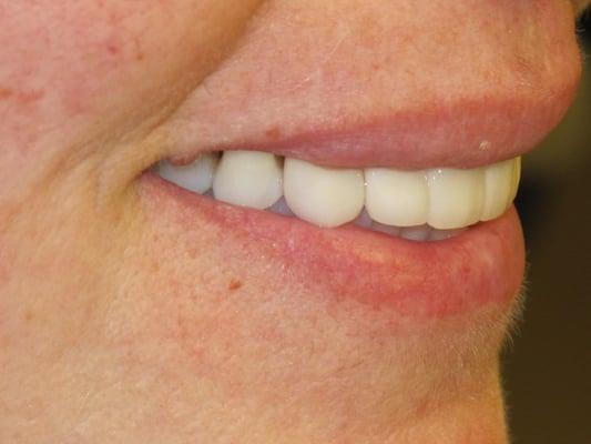 After : Crowns on upper front teeth.