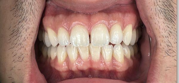 Before diastema/front teeth gap closure - dental assistant helped take a photo. Excuse the close up!