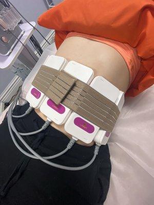 Laser lipo session